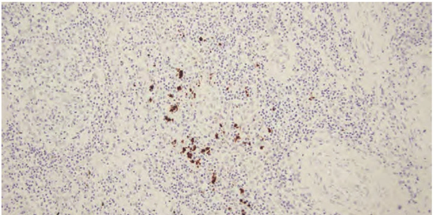 101 kroků: In situ hybridizace (ISH) - BARIA